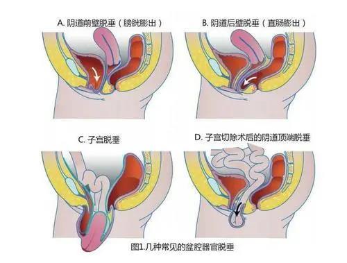 【医师节科普】盆腔器官脱垂了怎么办？