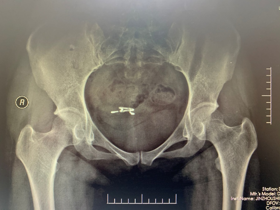 【医疗时讯】被“忽视”的节育环
