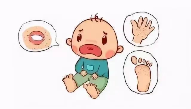 【健康科普】大手牵小手 预防手足口——手足口病预防知识