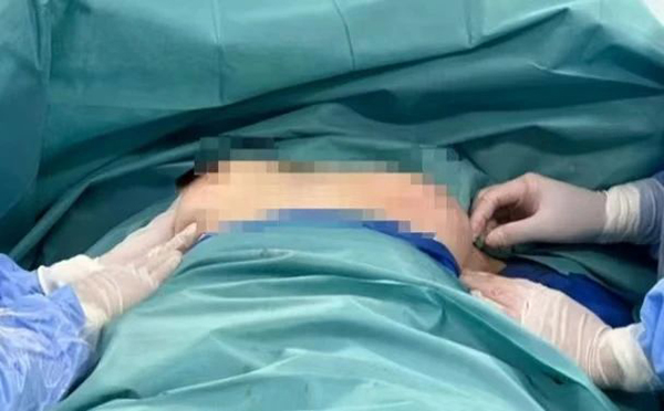 【优势技术】根治肿瘤 留住美丽——乳腺外科成功开展乳腺癌保留乳头乳晕皮下腺体切除术+胸肌前假体联合TiLOOP补片植入乳房重建术