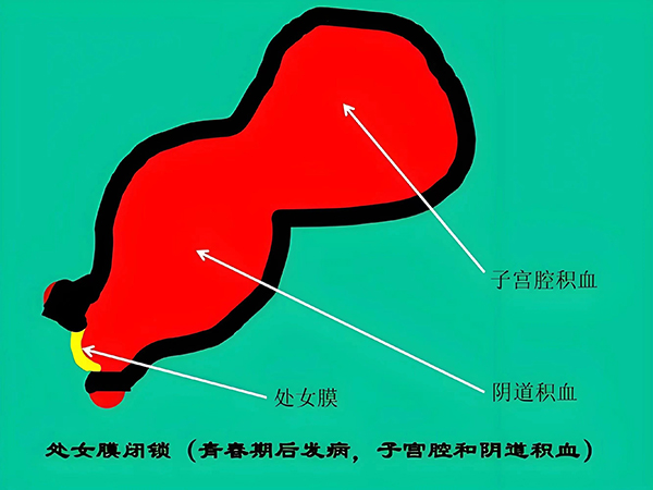 【健康科普】青春期女孩周期性腹痛——究竟哪里出了问题？