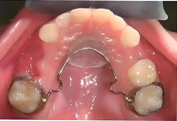 【健康科普】儿童牙齿早失与间隙保持器