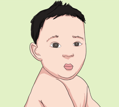 【健康科普】罕见的9q重复综合征：小男婴浩浩的警示