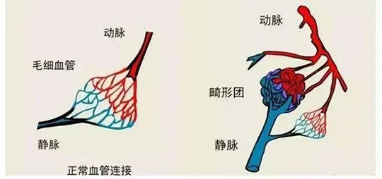 【健康科普】深入了解子宫动静脉瘘：流产后的潜在威胁