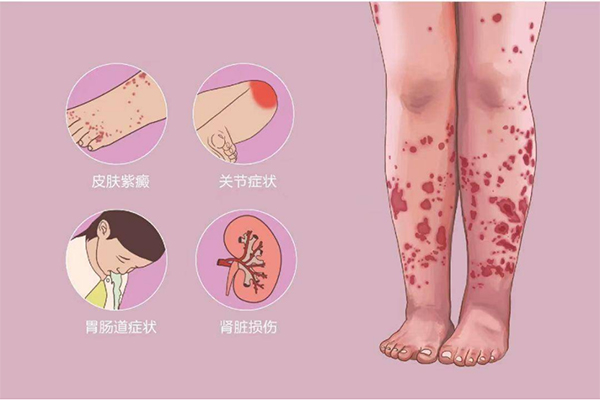 【健康科普】儿童血小板减少之自身免疫性血小板减少症（ITP）全解析