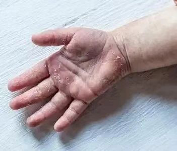 【健康科普】猩红热：看似寻常却需警惕的儿童传染病