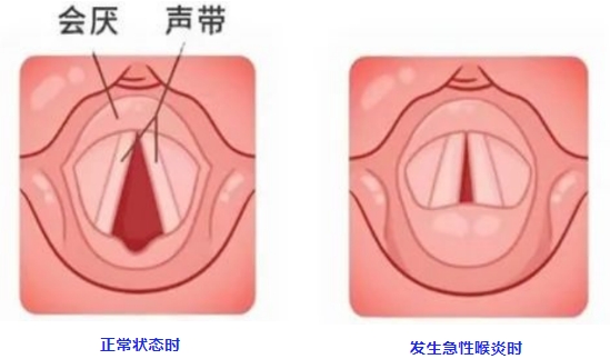【健康科普】别忽视！小儿急性喉炎的那些事儿