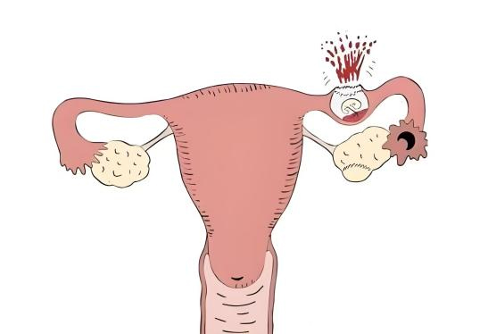 【有温度的医者】春节里的生死时速——妇二科宫外孕大出血抢救纪实