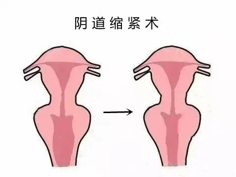 【优势技术】重寻幸福：阴道紧缩术让爱回归
