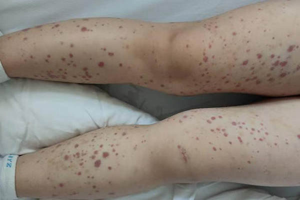 【健康科普】孩子皮肤出现“小红点”，千万别大意