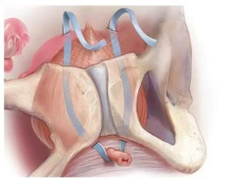 【优势技术】一条小“吊带”，让张阿姨告别压力性尿失禁，重启幸福生活