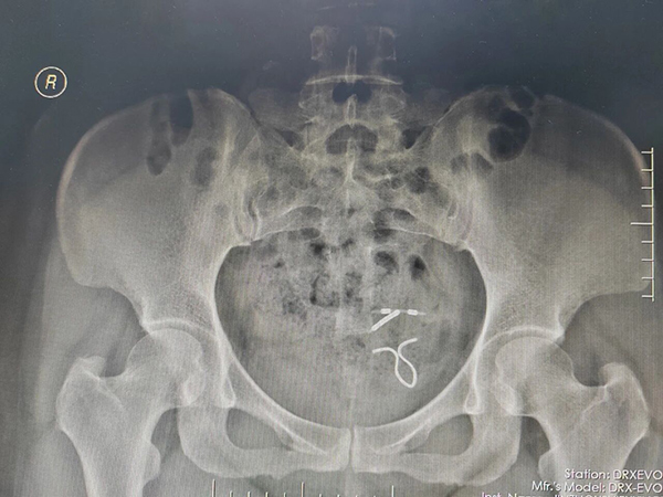 【优势技术】体内惊现两个“环”？女子节育器“出逃”腹腔，单孔腹腔镜轻松化解