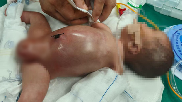 【优势专科】早产宝宝“肠”危机，多学科生死救援！