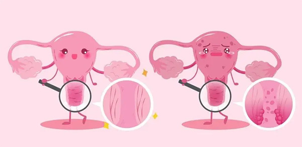 【健康科普】HPV和TCT是个啥？一文看懂宫颈癌筛查