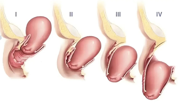 【健康科普】小小子宫托，解决大问题